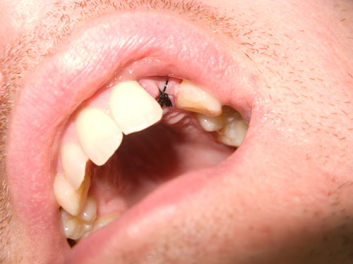 where my tooth used to be