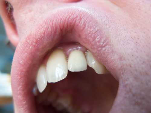crowned tooth